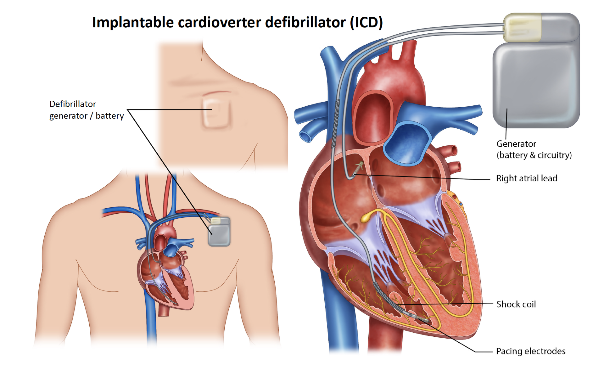 Defibrilllator Implant Melbourne Heart Group