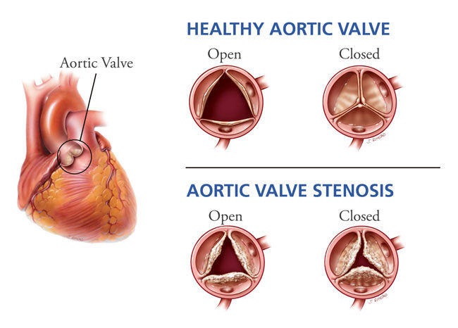 TAVI info 1